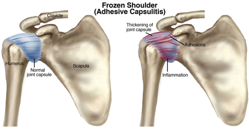 Výsledek obrázku pro frozen shoulder syndrom